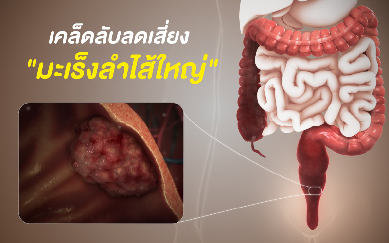 เคล็ดลับลดเสี่ยง "มะเร็งลำไส้ใหญ่"