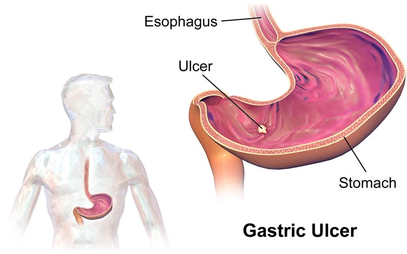 การตรวจสุขภาพ : แผลในกระเพาะอาหาร...โรคสุดทรมานที่รักษาได้