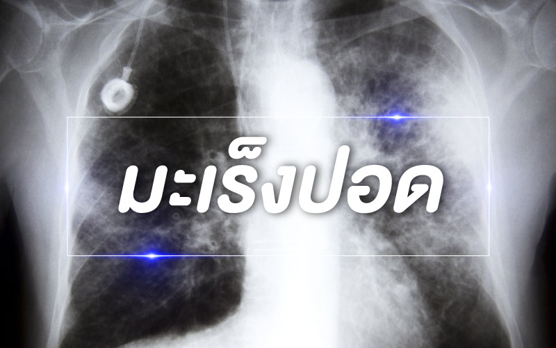 โรคทั่วไป : มะเร็งปอด (Lung Cancer)