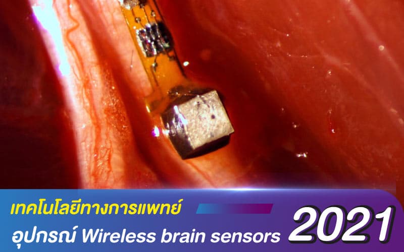 เทคโนโลยีทางการแพทย์ 2021 กับอุปกรณ์ Wireless brain sensors