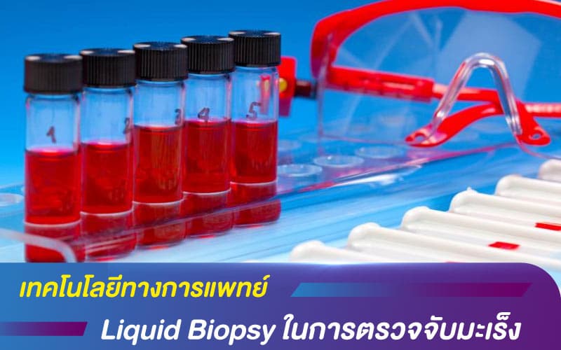 เทคโนโลยีทางการแพทย์ Liquid Biopsy เครื่องตรวจพิสูจน์ของเหลว ในการตรวจจับมะเร็ง