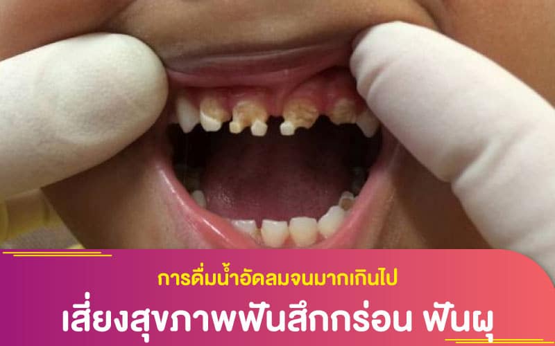 การดื่มน้ำอัดลมจนมากเกินไป เสี่ยงสุขภาพฟันสึกกร่อน ฟันผุ และการดูแลช่องปากของคุณ